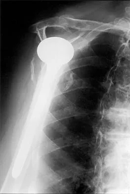 Shoulder 2026 MCQs: Board Review Questions & Answers (Part 2) - Figure 61