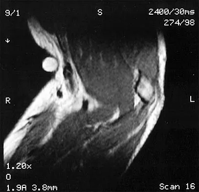 Shoulder 2026 MCQs: Board Review Questions & Answers (Part 2) - Figure 93