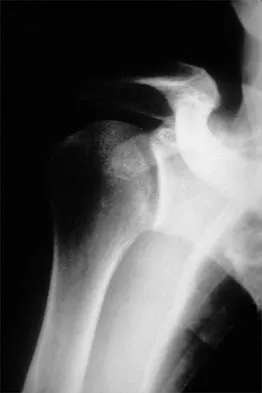 AAOS Orthopedic Shoulder MCQs (Part 4): Rotator Cuff & Instability | 2026 Board Review