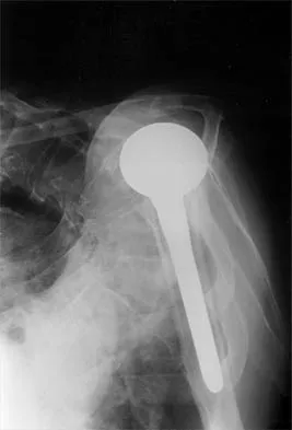 Shoulder 2026 MCQs: Board Review Questions & Answers (Part 4) - Figure 11