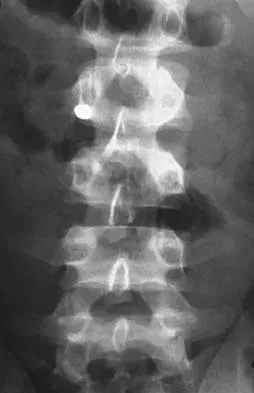 Spine 2026 MCQs: Board Review Questions & Answers (Part 1) - Figure 141