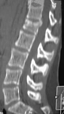 Spine 2026 MCQs: Board Review Questions & Answers (Part 1) - Figure 155