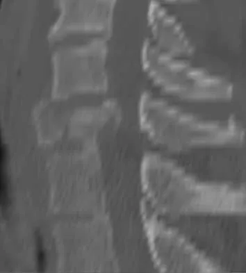 Spine 2026 MCQs: Board Review Questions & Answers (Part 1) - Figure 51