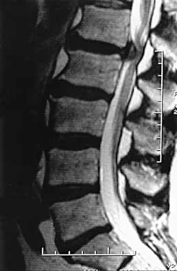 Spine 2026 MCQs: Board Review Questions & Answers (Part 1) - Figure 75