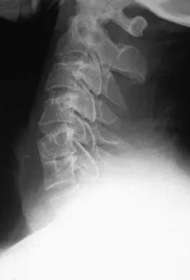 AAOS Orthopedic Spine MCQs (Part 2): Trauma, Degenerative & Scoliosis | 2026 Board Review