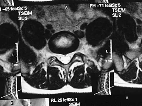 Spine 2026 MCQs: Board Review Questions & Answers (Part 2) - Figure 38