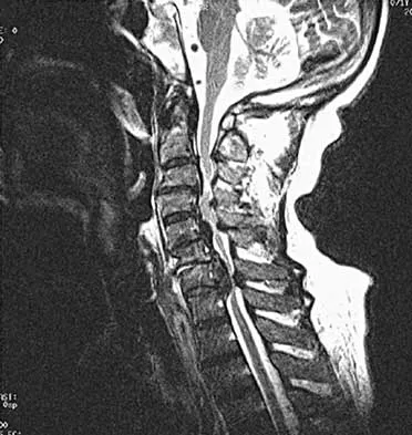 Spine 2026 MCQs: Board Review Questions & Answers (Part 2) - Figure 42