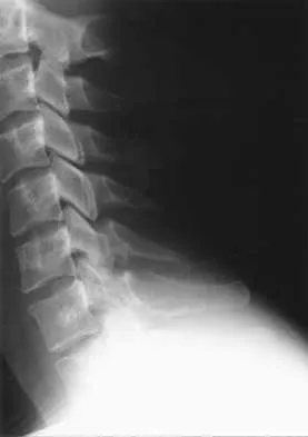 Spine 2026 MCQs: Board Review Questions & Answers (Part 2) - Figure 70