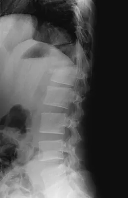 Spine 2026 MCQs: Board Review Questions & Answers (Part 2) - Figure 85