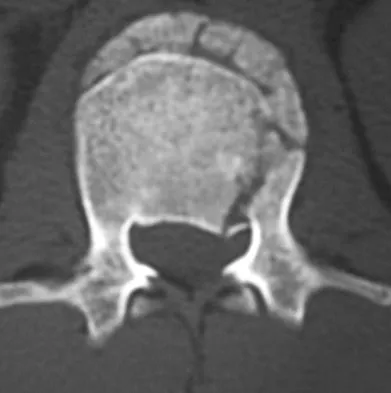 Spine 2026 MCQs: Board Review Questions & Answers (Part 2) - Figure 87