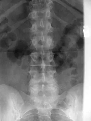 AAOS Spine Surgery MCQs (Set 1): Degenerative, Trauma & Deformity | ABOS Board Review 2024