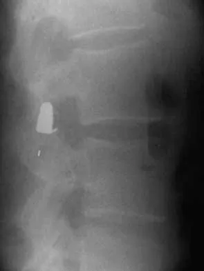 Spine Surgery 2000 Practice Questions: Set 1 (Solved) - Figure 15