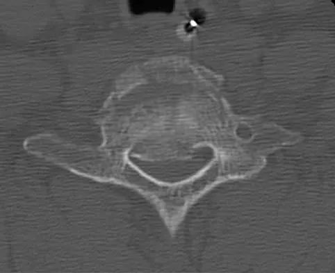 Spine Surgery 2000 Practice Questions: Set 1 (Solved) - Figure 33