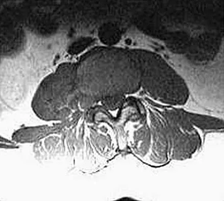 AAOS Spine Surgery MCQs (Set 3): Degenerative Spine, Trauma & Deformity | ABOS & OITE Review