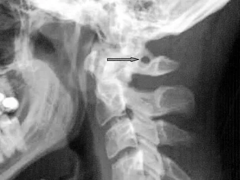 Spine Surgery Board Review 2006: High-Yield MCQs (Set 2) - Figure 6