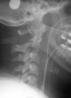 Spine Surgery 2006 Practice Questions: Set 3 (Solved) - Figure 1