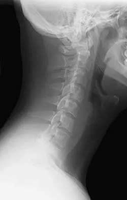 AAOS & ABOS Spine Surgery MCQs (Set 4): Spinal Trauma, Cervical Myelopathy & Adult Scoliosis