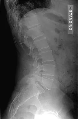 AAOS Spine Surgery MCQs (Set 1): Spinal Trauma, Degenerative Disc & Deformity