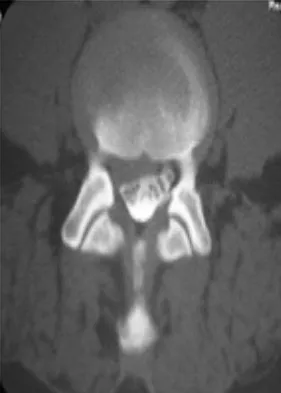Spine Surgery 2009 Practice Questions: Set 1 (Solved) - Figure 14