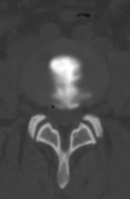 Spine Surgery 2009 Practice Questions: Set 1 (Solved) - Figure 20