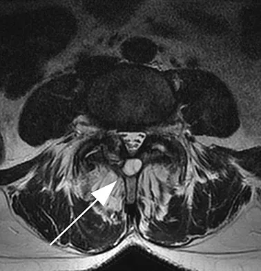 Spine Surgery Board Review 2009: High-Yield MCQs (Set 2) - Figure 11
