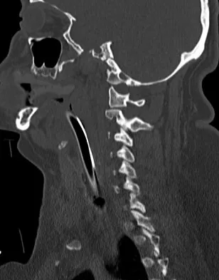 Spine Surgery Board Review 2009: High-Yield MCQs (Set 2) - Figure 13