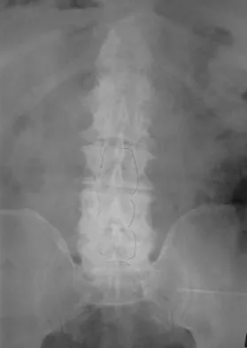 Spine Surgery Board Review 2009: High-Yield MCQs (Set 2) - Figure 18