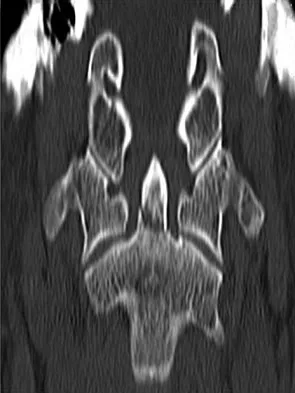 Spine Surgery Board Review 2009: High-Yield MCQs (Set 2) - Figure 4