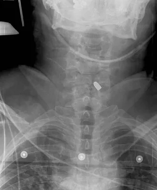 Spine Surgery 2009 Practice Questions: Set 3 (Solved) - Figure 15