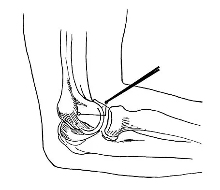Sports Medicine Board Review 2001: High-Yield MCQs (Set 2) - Figure 14