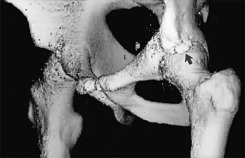 AAOS & ABOS Orthopedic 2026 MCQs: Compartment Syndrome, Femoral Fractures & Knee Injuries
