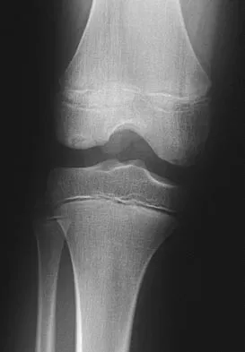 Sports Medicine 2004 Practice Questions: Set 1 (Solved) - Figure 11