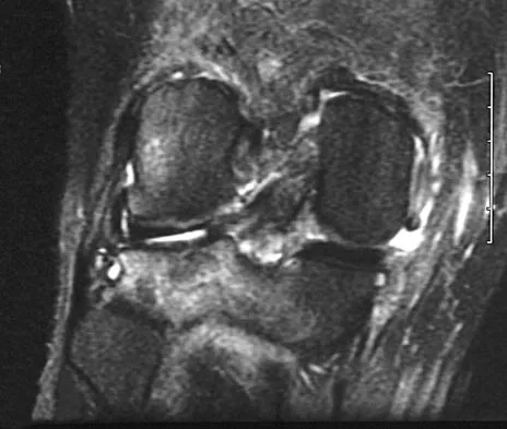 Sports Medicine Board Review 2004: High-Yield MCQs (Set 2) - Figure 19