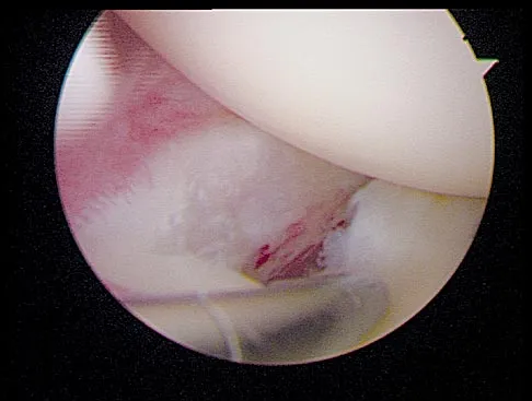 Sports Medicine Board Review 2004: High-Yield MCQs (Set 2) - Figure 6