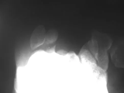 Sports Medicine Board Review 2007: High-Yield MCQs (Set 2) - Figure 11