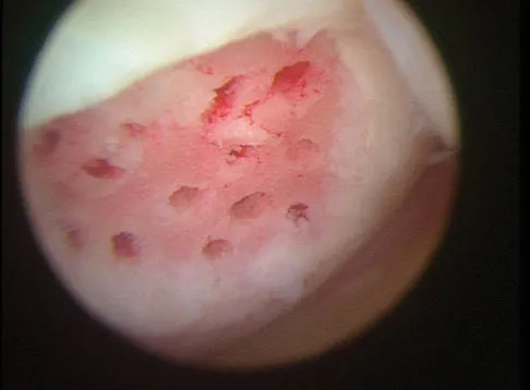 Sports Medicine Board Review 2007: High-Yield MCQs (Set 2) - Figure 6