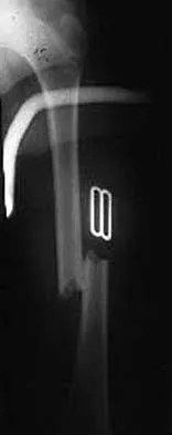 Trauma 2000 Practice Questions: Set 1 (Solved) - Figure 13