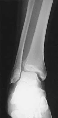 AAOS, ABOS, SMLE Orthopedic Trauma MCQs (Set 4): Tibial Plateau, Pilon, & Polytrauma Management