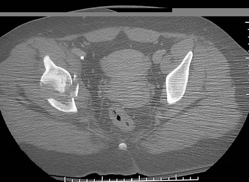 Trauma 2006 Practice Questions: Set 1 (Solved) Figure 3