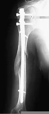 AAOS Orthopedic Trauma MCQs (Set 1): Emergency & Fracture Management | Board Review