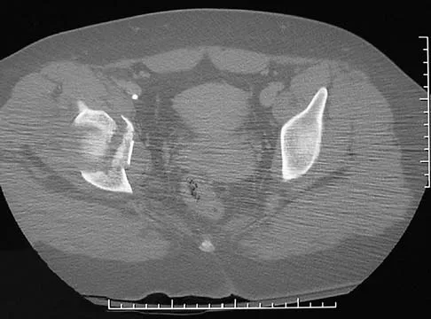 Trauma 2006 Practice Questions: Set 1 (Solved) - Figure 14