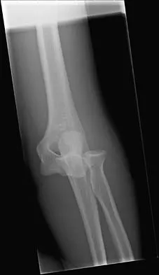 Orthopedic Trauma Board Review MCQs (Set 2): Femoral & Tibial Fractures, Shoulder Dislocations