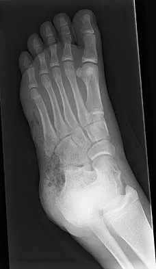 AAOS & ABOS Orthopedic Trauma MCQs (Set 4): Pelvic, Acetabular & Lower Extremity Fractures