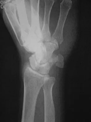 AAOS Orthopedic Trauma MCQs (Set 3): Lower & Upper Extremity Fractures | Board Review