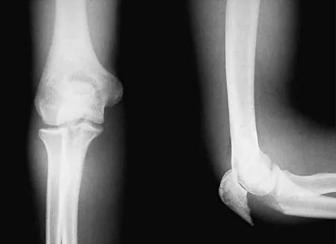 AAOS & ABOS Orthopedic Trauma MCQs (Part 2): Fracture Management & Joint Injuries | 2026 Board Review
