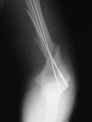 Trauma 2026 MCQs: Board Review Questions & Answers (Part 2) - Figure 33