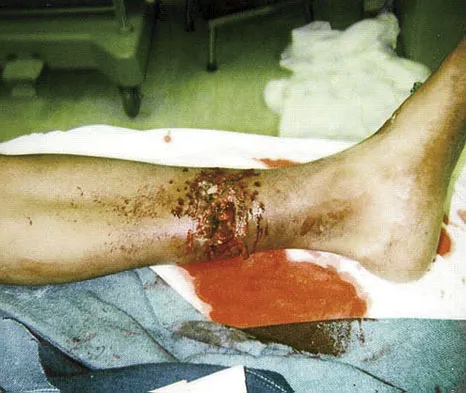 Trauma 2026 MCQs: Board Review Questions & Answers (Part 3) - Figure 93