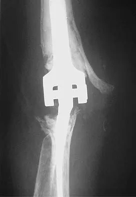Upper Extremity Board Review 2005: High-Yield MCQs (Set 2) - Figure 10