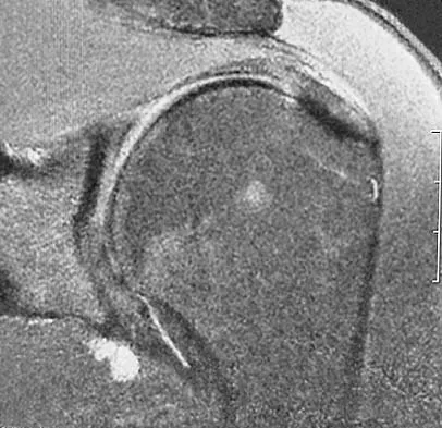 Upper Extremity Board Review 2005: High-Yield MCQs (Set 2) - Figure 14