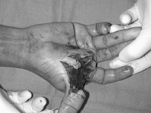 Upper Extremity Board Review 2005: High-Yield MCQs (Set 2) - Figure 31